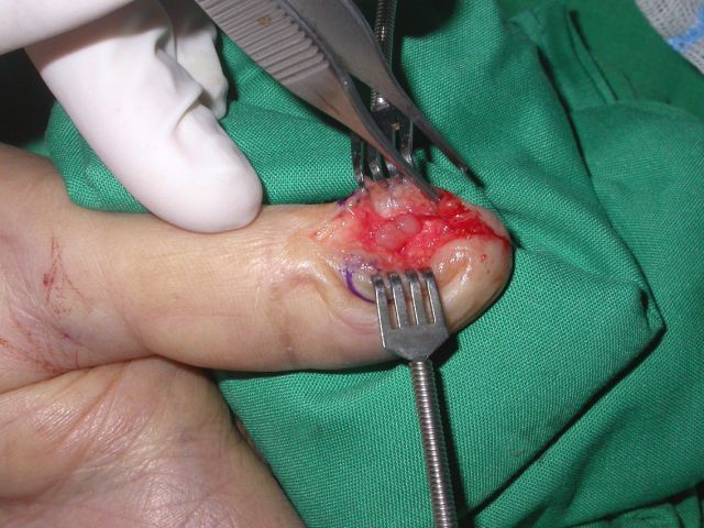 גידול גלומוס באצבע Glomus tumor in finger