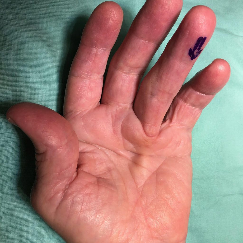 צילום של יד עם דופיטרן