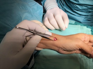 צילום קליני במהלך ניתוח דה קרוון או דיקרוון