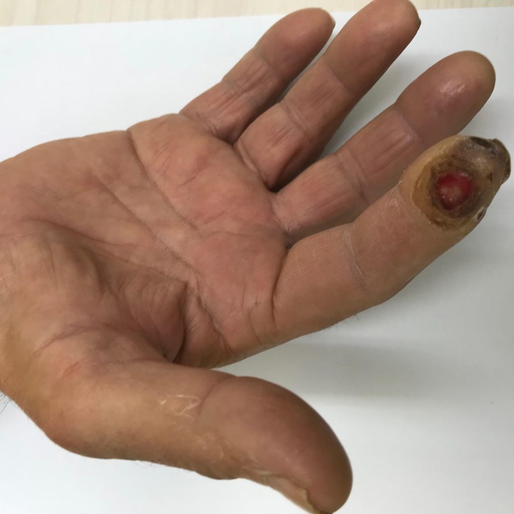 פצע באצבע של כף יד