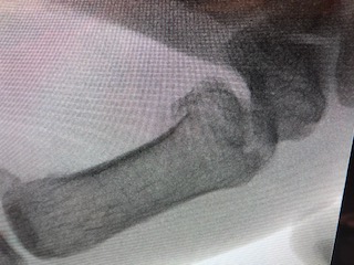 צילום רנטגן שבר מסוג בנט בסיס האגודל
